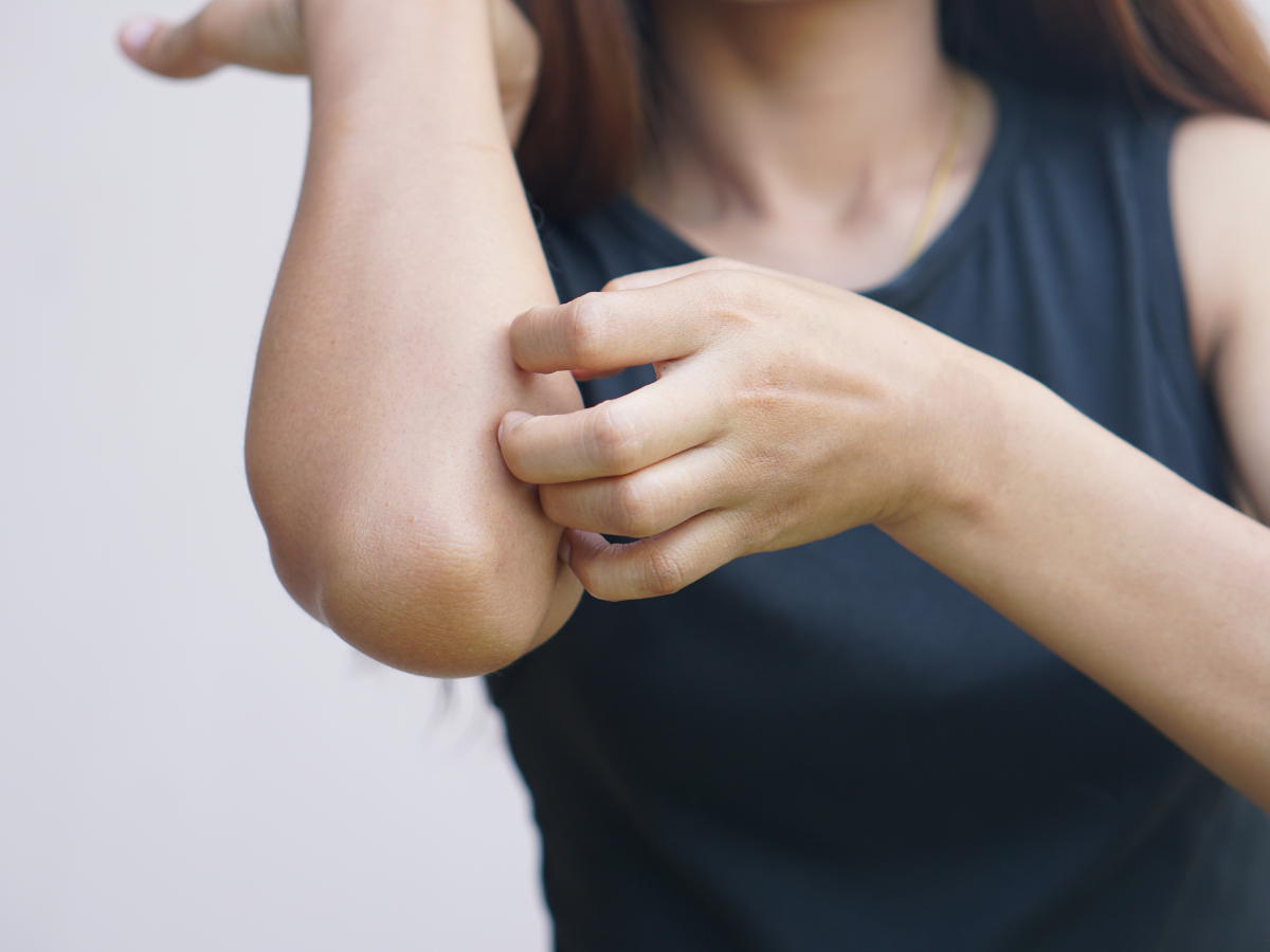 Stock Image of a girl scratching the skin on her elbow, face out of view